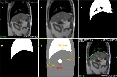 Association Between Internal Organ/Liver Tumor and External Surface Motion From Cine MR Images on an MRI-Linac